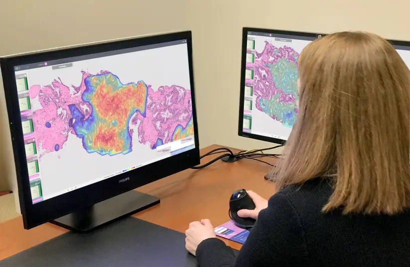 The Ibex solution promises to greatly impact the care given to breast cancer patients. Israeli artificial intelligence (AI) cancer diagnostic company Ibex Medical Analytics and Hartford HealthCare, which has more than 400 locations serving more than 17,000 people daily, announced on Monday a clinical research and innovation collaboration to implement Ibex's AI solution to improve breast cancer diagnosis. The partnership, which involves Ibex's Galen Breast diagnostic algorithm, supports pathologists by providing AI insights that help detect and grade various types of invasive and non-invasive breast cancer. The solution was developed by a team of pathologists, data scientists and software engineers who implemented advanced deep learning technologies and trained algorithms on hundreds of thousands of image samples. Breast cancer is the most common malignant disease in women worldwide, with over 2 million new cases each year. Early and accurate detection is critical for effective treatment and saving women's lives. Hartford HealthCare is among the first health organizations in America to use artificial intelligence technology to help pathologists with cancer diagnosis and to improve patient care. Dr. Barry Stein, the system’s vice president and chief clinical innovation officer, said: “Even though patients rarely interact with the pathologists examining their tissue samples, their interpretive expertise greatly affects the care received." Dr. Srini Mandavilli, chief of pathology and laboratory medicine at Hartford Hospital, added that such technology has the potential to help the traditional microscopic evaluation of cancers done by pathologists. This could complement the work in a positive way, and be of help particularly at a time when pathologist staffing and recruitments are challenging amid a global increase in cancer cases. The department has started using digital pathology (digitizing tissue sections on glass slides) with slide scanners, which Mandavilli said allows the material to be evaluated by AI technology. Hartford HealthCare pathologists could begin using Galen to examine all cases after they review slides on the microscope, added Dr. Margaret Assad, program director of the selective pathology fellowship at Hartford Hospital. “This AI assistant provides a higher safety net with minimal, additional effort,” she said. “We are proud to partner with Hartford HealthCare to support their ongoing digital transformation,” said Joel Duckworth, chief revenue officer at Ibex Medical Analytics. “We are committed to helping all of our customers provide precise, timely and personalized diagnosis to all patients. With Ibex’s trusted AI and advanced digital pathology technologies, Hartford HealthCare can empower their pathologists to deliver highly accurate and prompt diagnoses, with the potential to directly impact prognosis for patients, setting a new standard in breast cancer care quality in the United States.” The collaboration is the latest part of Hartford HealthCare’s 2020 strategic partnership with the Israeli Innovation Authority to advance solutions that improve access, quality and safety, and patient experience, according to David Whitehead, executive vice president and chief strategy and transformation officer at Hartford HealthCare. “In forging this vital connection, Hartford HealthCare took a tremendous step forward in its commitment to collaborate with Israeli companies like Ibex and develop innovative technologies, products and services within the healthcare sector,” Whitehead said.
